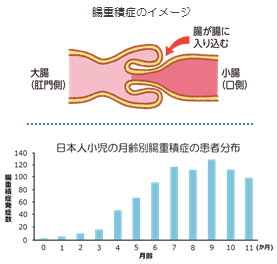 腸重積症