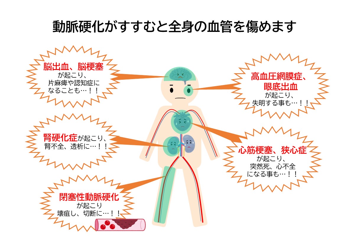 動脈硬化で起こる疾患
