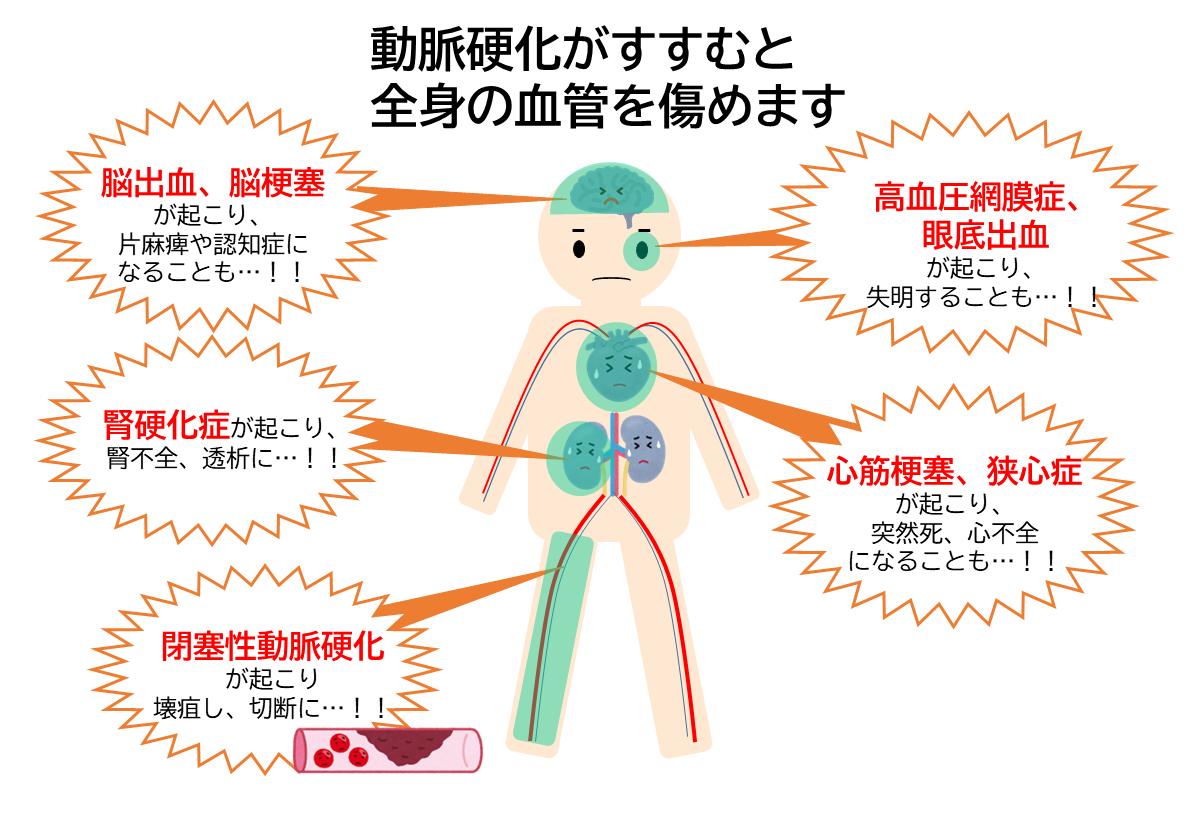 動脈硬化